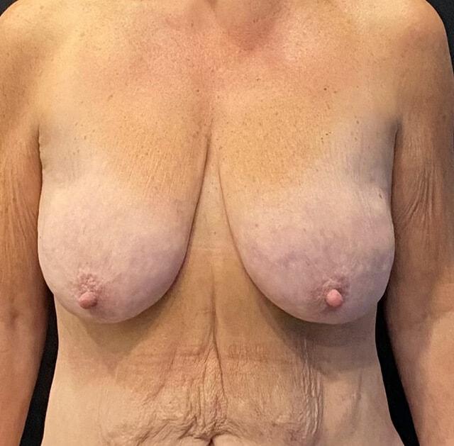 Breast Lift before at Jonathan A. Schwitzer, MD Plastic Surgery in Bay Harbor Islands, FL