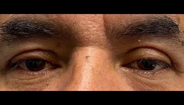 Blepharoplasty after at Jonathan A. Schwitzer, MD Plastic Surgery in Bay Harbor Islands, FL