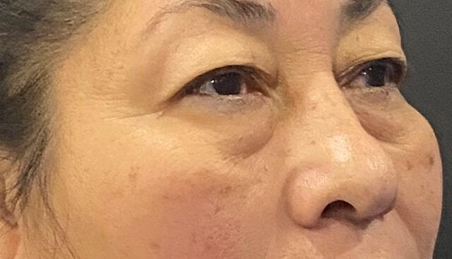 Blepharoplasty before at Jonathan A. Schwitzer, MD Plastic Surgery in Bay Harbor Islands, FL