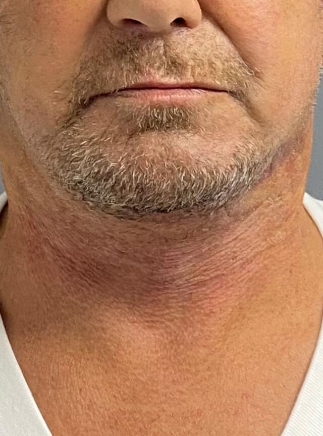 Facelift after at Jonathan A. Schwitzer, MD Plastic Surgery in Bay Harbor Islands, FL