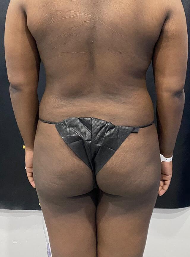 Brazilian Butt Lift before at Jonathan A. Schwitzer, MD Plastic Surgery in Bay Harbor Islands, FL