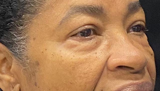 Blepharoplasty before at Jonathan A. Schwitzer, MD Plastic Surgery in Bay Harbor Islands, FL