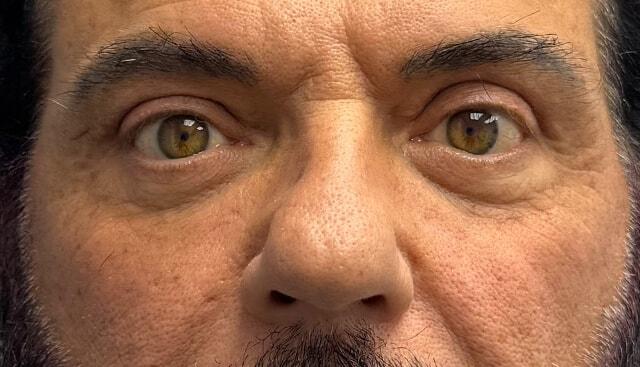 Blepharoplasty after at Jonathan A. Schwitzer, MD Plastic Surgery in Bay Harbor Islands, FL