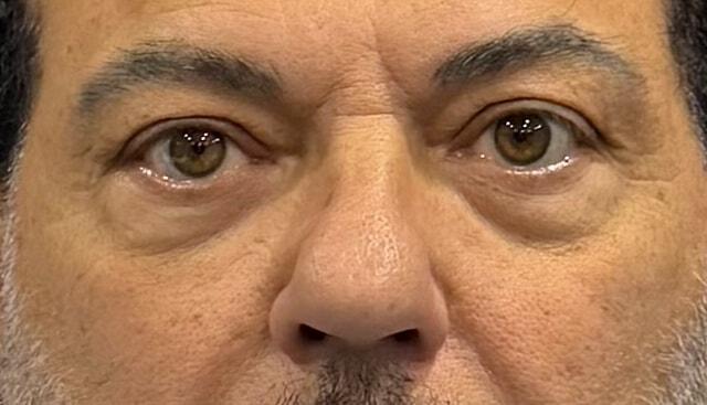 Blepharoplasty before at Jonathan A. Schwitzer, MD Plastic Surgery in Bay Harbor Islands, FL