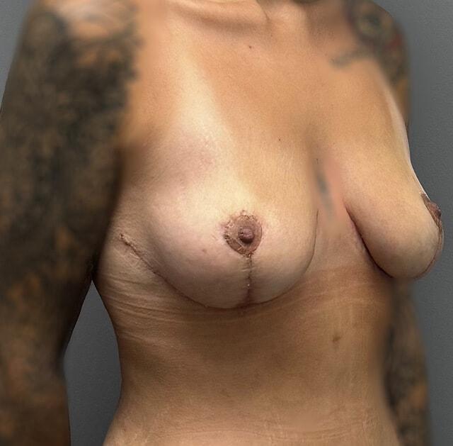 Breast Lift after at Jonathan A. Schwitzer, MD Plastic Surgery in Bay Harbor Islands, FL