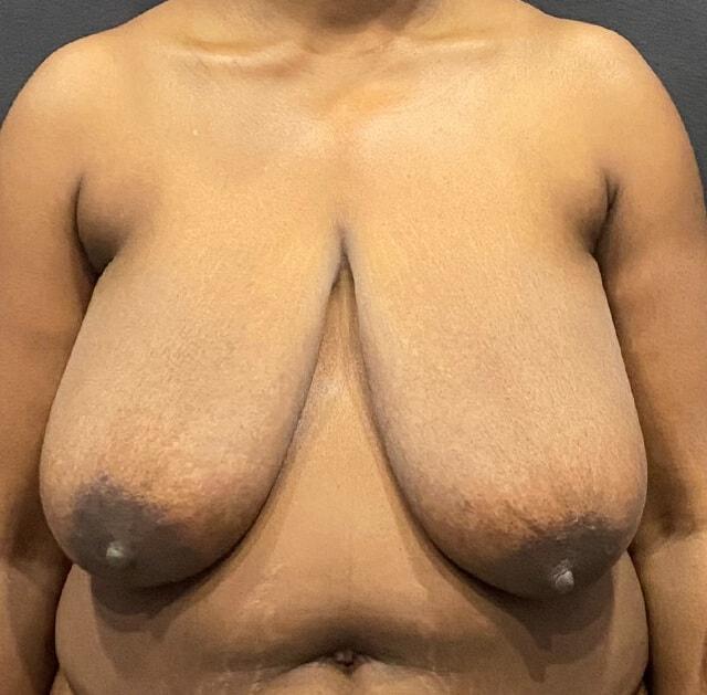 Breast Reduction before at Jonathan A. Schwitzer, MD Plastic Surgery in Bay Harbor Islands, FL