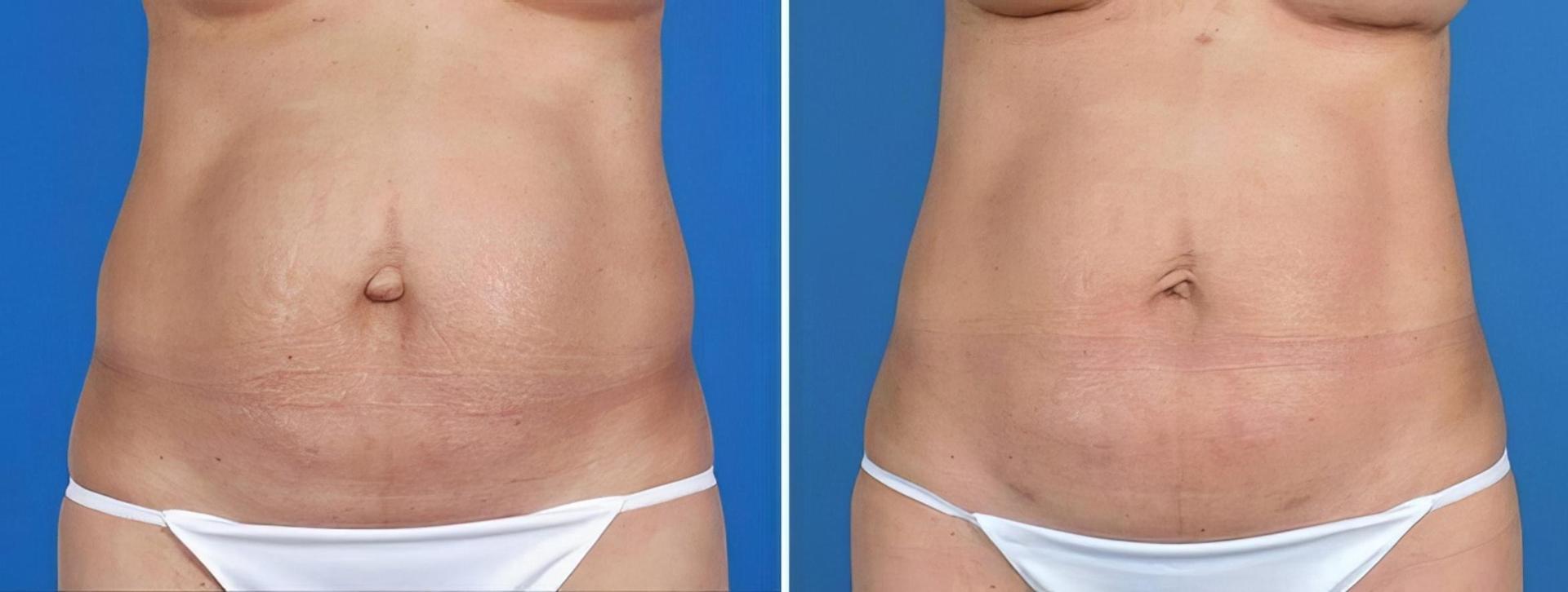 The Swan Center for Plastic Surgery liposuction result — Alpharetta, GA