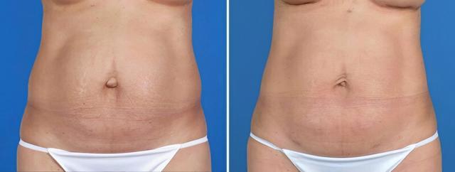 Liposuction result at The Swan Center for Plastic Surgery in Alpharetta, GA