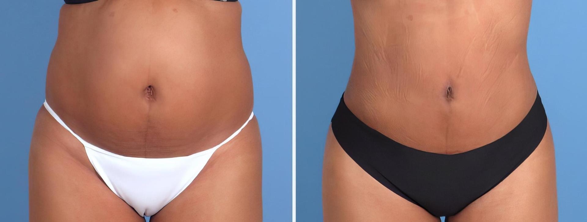 The Swan Center for Plastic Surgery liposuction result — Alpharetta, GA