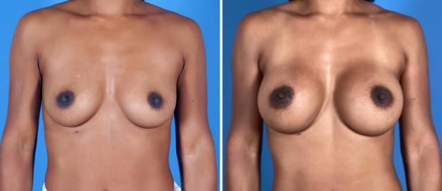 Fat Transfer Breast Augmentation result at The Swan Center for Plastic Surgery in Alpharetta, GA