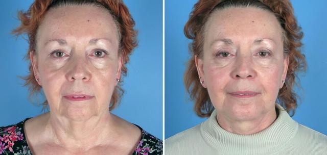 Deep Plane Facelift result at The Swan Center for Plastic Surgery in Alpharetta, GA