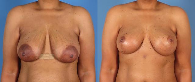 Mommy Makeover result at The Swan Center for Plastic Surgery in Alpharetta, GA