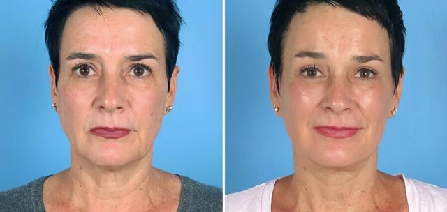 Deep Plane Facelift result at The Swan Center for Plastic Surgery in Alpharetta, GA