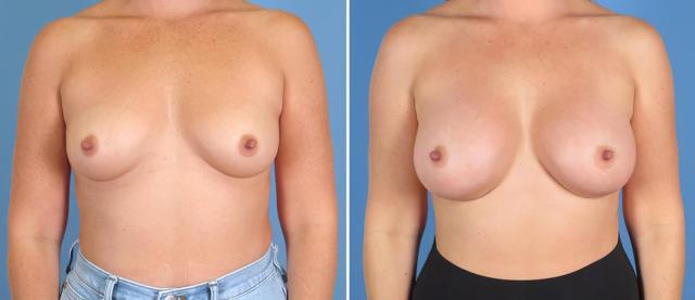 Fat Transfer Breast Augmentation result at The Swan Center for Plastic Surgery in Alpharetta, GA