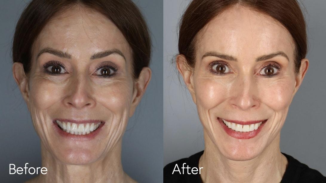 Omar N. Hussain, MD facelift result — Beverly Hills, CA