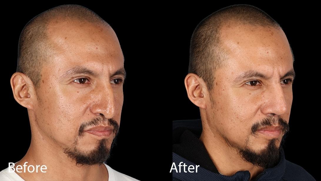 Omar N. Hussain, MD rhinoplasty result — Beverly Hills, CA