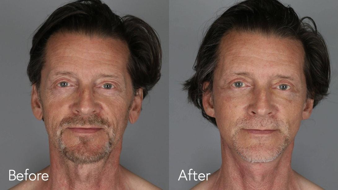 Omar N. Hussain, MD facelift result — Beverly Hills, CA
