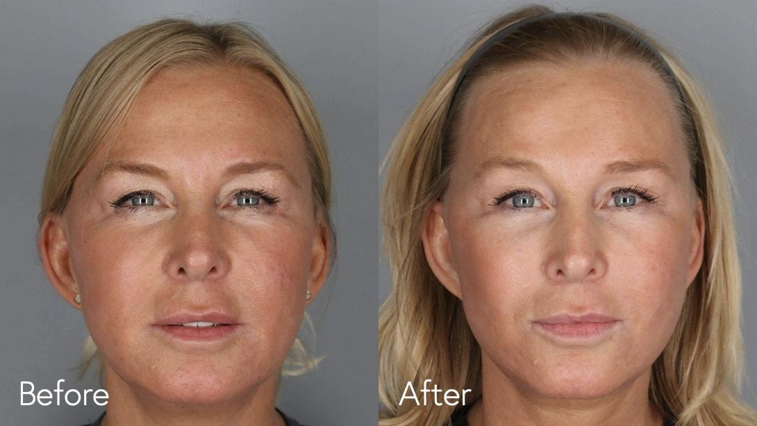 Omar N. Hussain, MD facelift result — Beverly Hills, CA