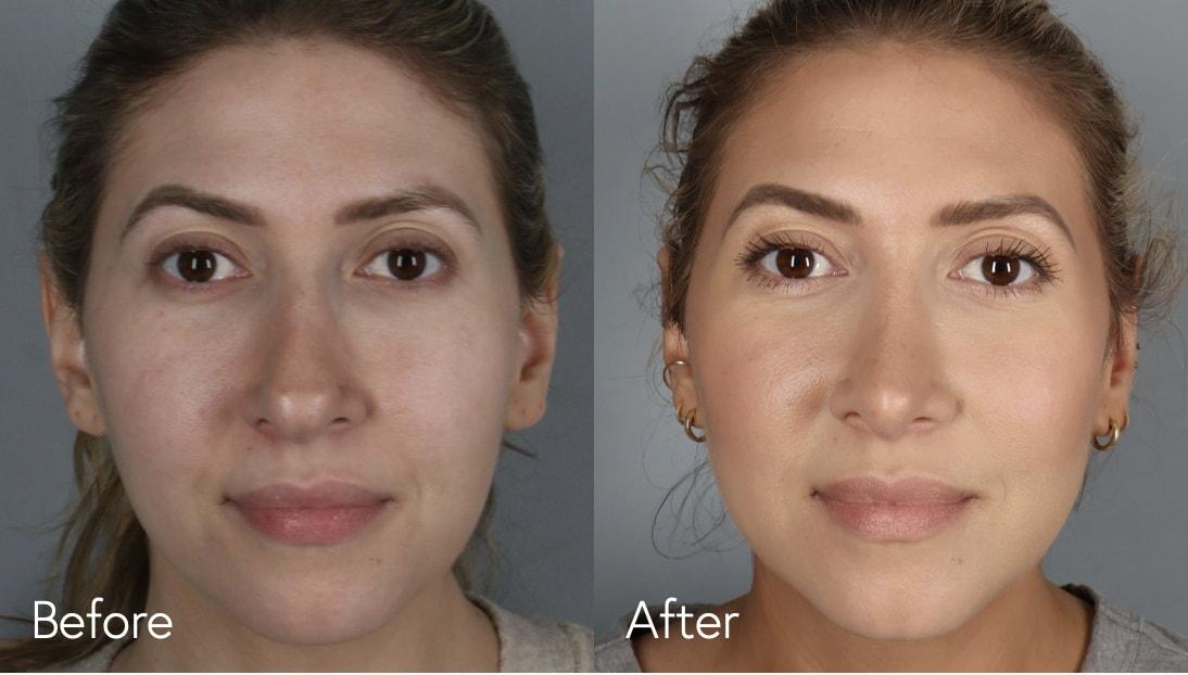 Omar N. Hussain, MD rhinoplasty result — Beverly Hills, CA
