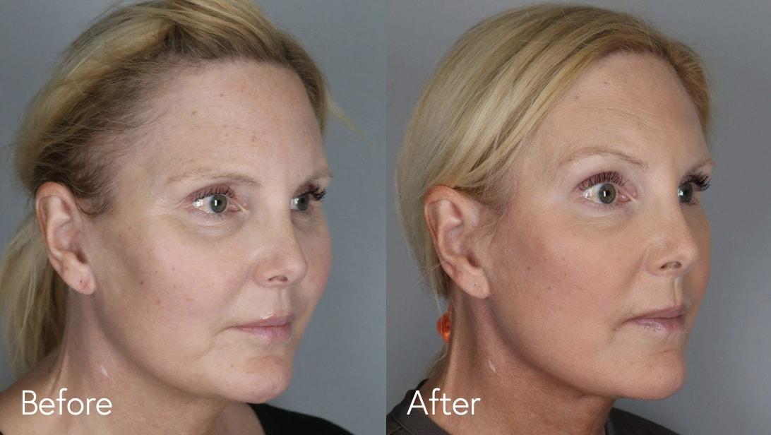 Omar N. Hussain, MD facelift result — Beverly Hills, CA
