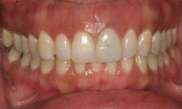 Smile Makeover after at Haley E. Schmitt, DDS Cosmetic & Family Dentistry in Brentwood, TN