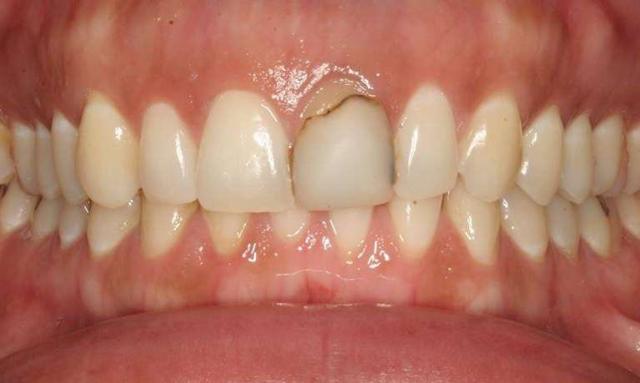 Smile Makeover before at Haley E. Schmitt, DDS Cosmetic & Family Dentistry in Brentwood, TN
