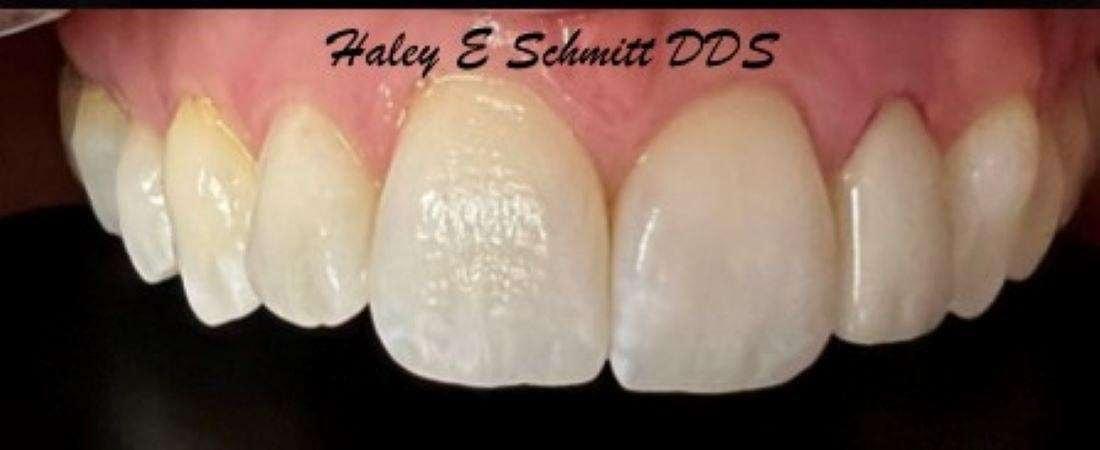 Haley E. Schmitt, DDS Cosmetic & Family Dentistry dental crowns after — Brentwood, TN