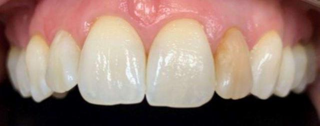 Dental Veneers before at Haley E. Schmitt, DDS Cosmetic & Family Dentistry in Brentwood, TN