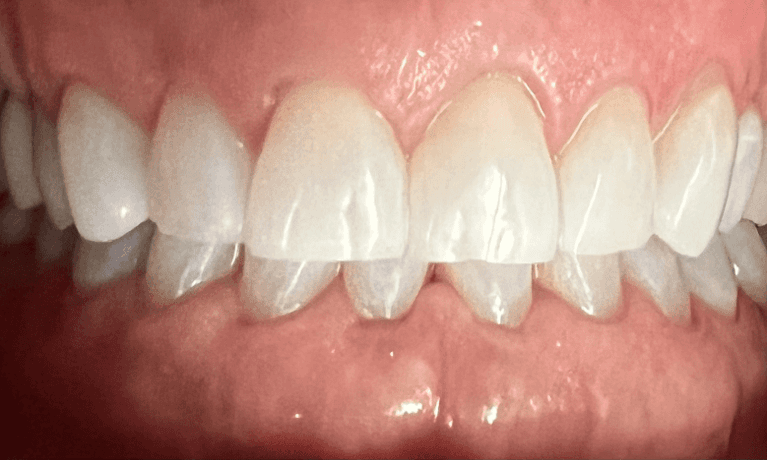 Haley E. Schmitt, DDS Cosmetic & Family Dentistry teeth whitening after — Brentwood, TN
