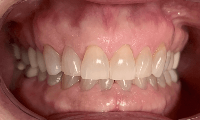 Teeth Whitening before at Haley E. Schmitt, DDS Cosmetic & Family Dentistry in Brentwood, TN