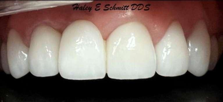Haley E. Schmitt, DDS Cosmetic & Family Dentistry dental crowns after — Brentwood, TN