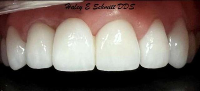 Gum Contouring after at Haley E. Schmitt, DDS Cosmetic & Family Dentistry in Brentwood, TN