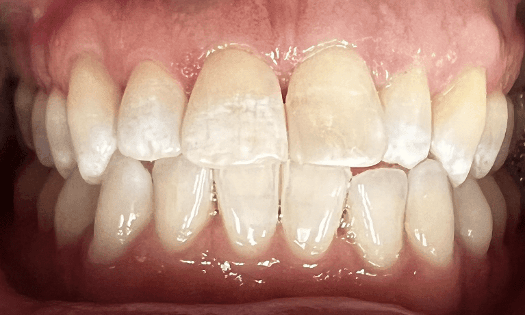 Haley E. Schmitt, DDS Cosmetic & Family Dentistry smile makeover after — Brentwood, TN