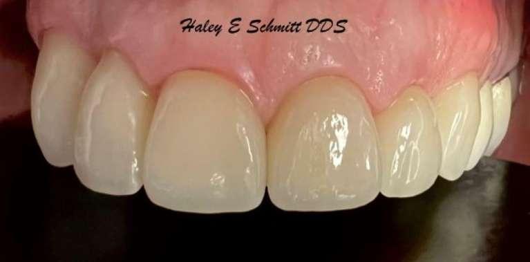 Haley E. Schmitt, DDS Cosmetic & Family Dentistry veneers after — Brentwood, TN