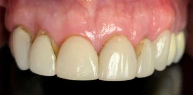 Dental Veneers before at Haley E. Schmitt, DDS Cosmetic & Family Dentistry in Brentwood, TN