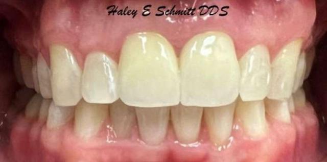 Dental Crowns after at Haley E. Schmitt, DDS Cosmetic & Family Dentistry in Brentwood, TN