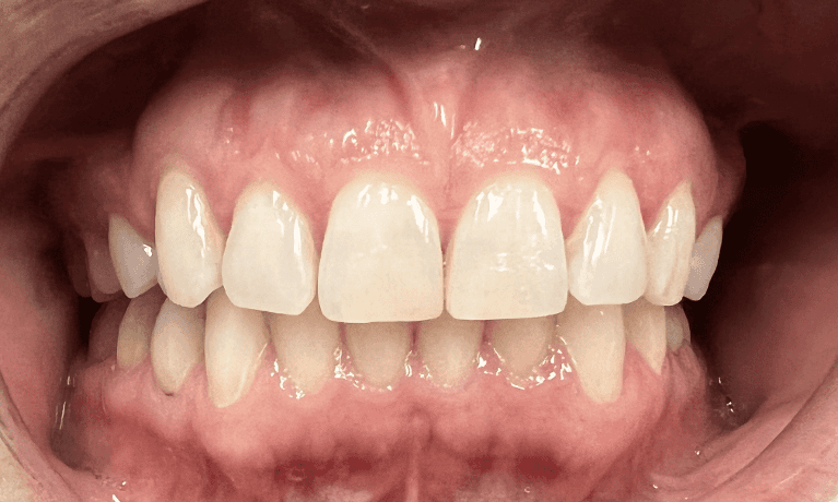 Haley E. Schmitt, DDS Cosmetic & Family Dentistry invisalign after — Brentwood, TN