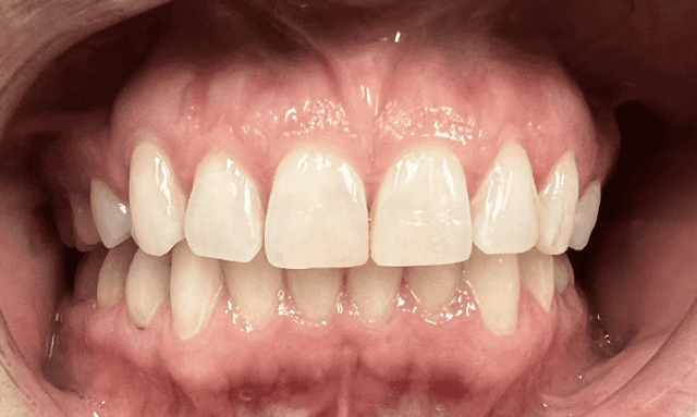 Invisalign after at Haley E. Schmitt, DDS Cosmetic & Family Dentistry in Brentwood, TN
