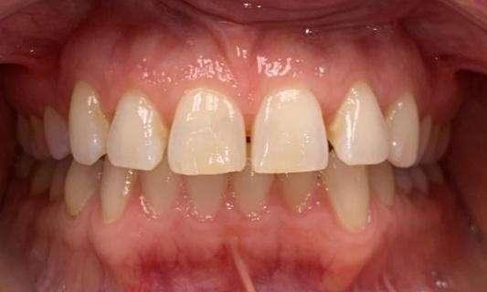 Invisalign before at Haley E. Schmitt, DDS Cosmetic & Family Dentistry in Brentwood, TN