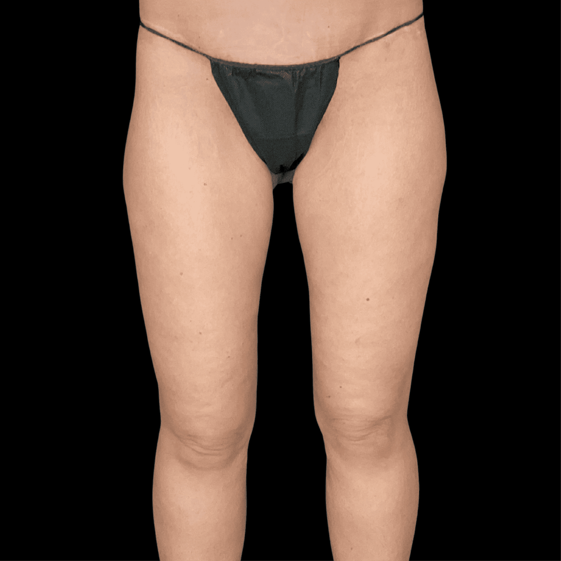 Campanile Plastic Surgery body lift after — Denver, CO