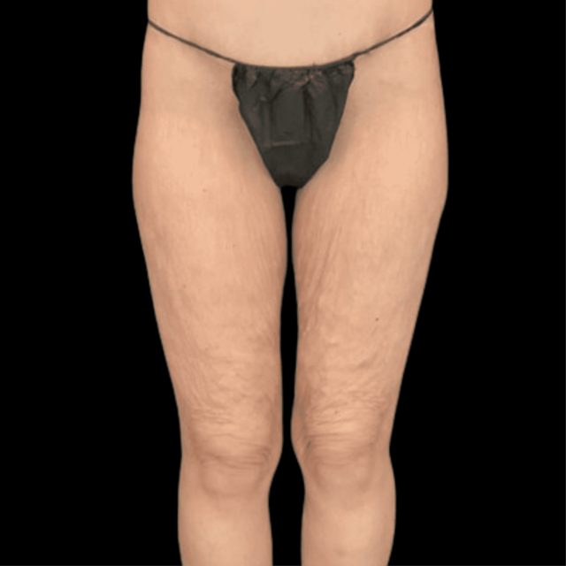 CoolSculpting before at Campanile Plastic Surgery in Denver, CO
