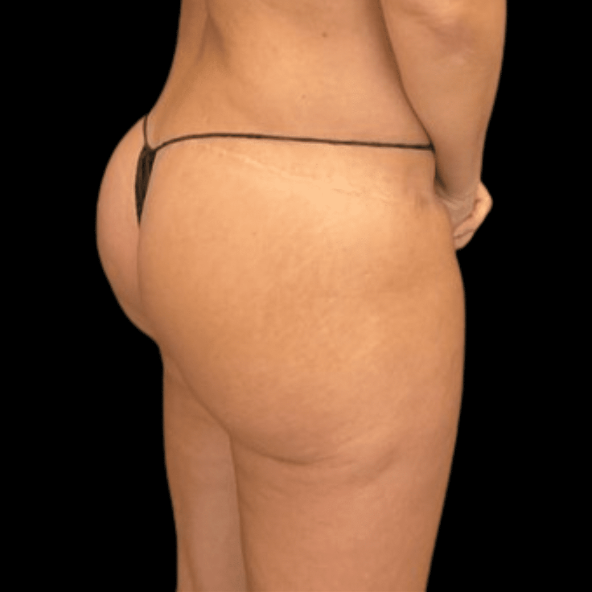 Campanile Plastic Surgery body lift after — Denver, CO