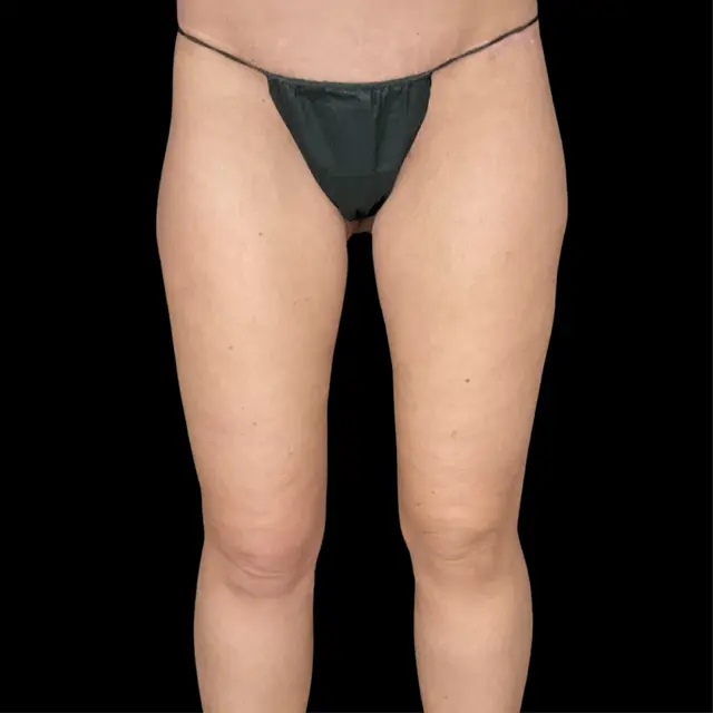 Thigh Lift after at Campanile Plastic Surgery in Denver, CO