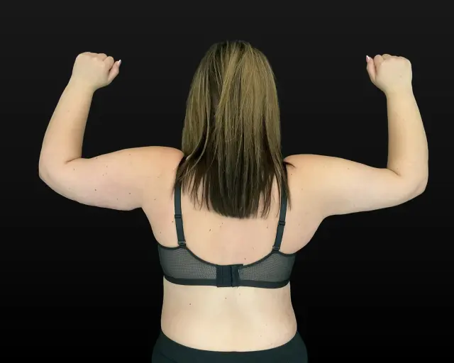 Arm Lift after at Campanile Plastic Surgery in Denver, CO