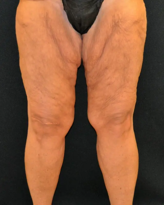 Thigh Lift before at Campanile Plastic Surgery in Denver, CO