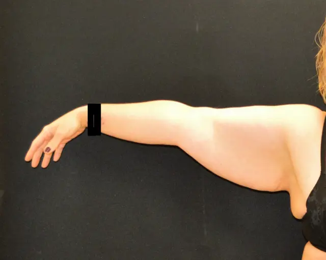 Arm Lift before at Campanile Plastic Surgery in Denver, CO