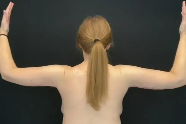 Arm Lift after at Campanile Plastic Surgery in Denver, CO