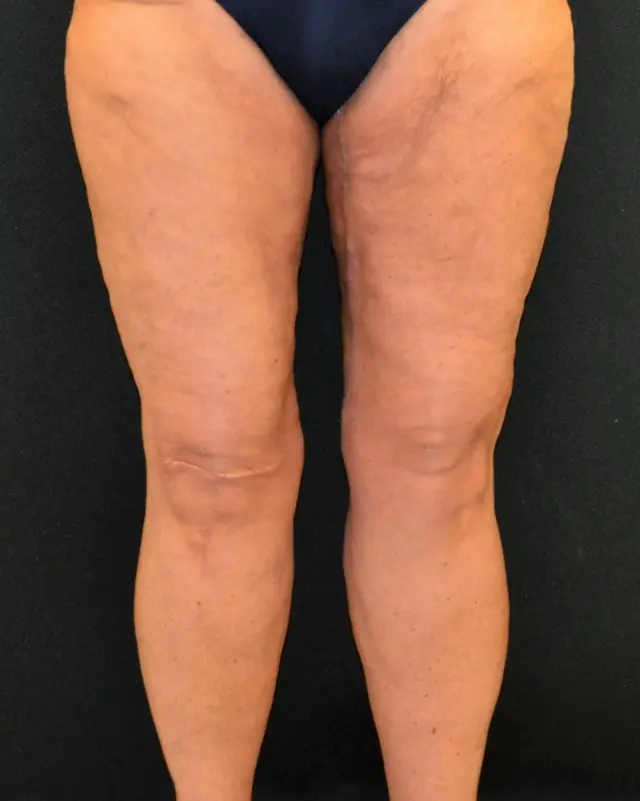 Thigh Lift after at Campanile Plastic Surgery in Denver, CO