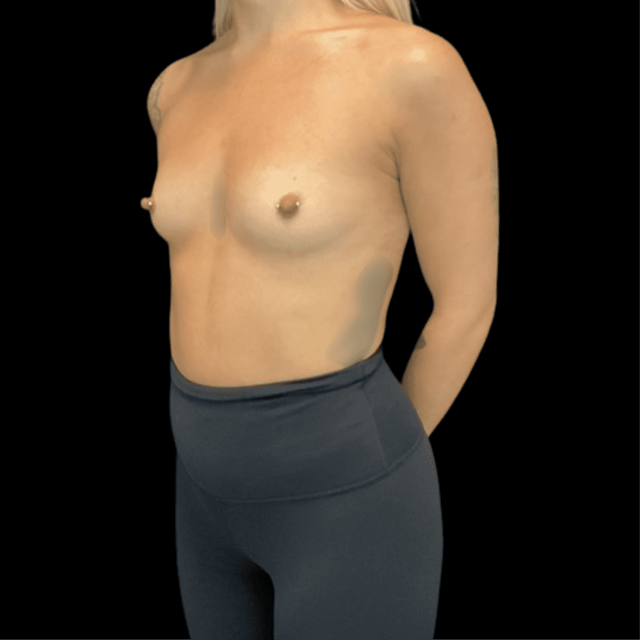 Breast Augmentation before at Campanile Plastic Surgery in Denver, CO
