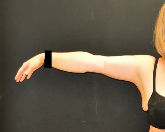Arm Lift after at Campanile Plastic Surgery in Denver, CO